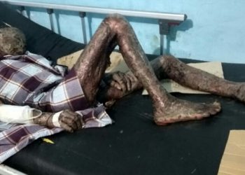 Kulit Melepuh dan Bersisik Seperti Ular, Pria ini Menderita Penyakit Aneh