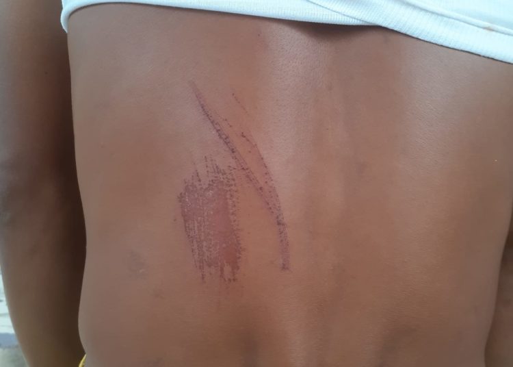 Punggung Hermawan tergores, diduga akibat tendangan kepala desa.