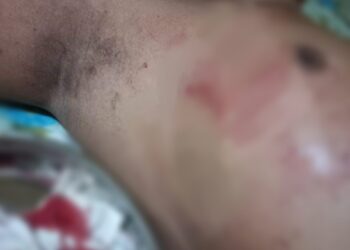 Sadis, Nyawa  Polisi di Buteng Nyaris Melayang Akibat Tikaman Pemabuk